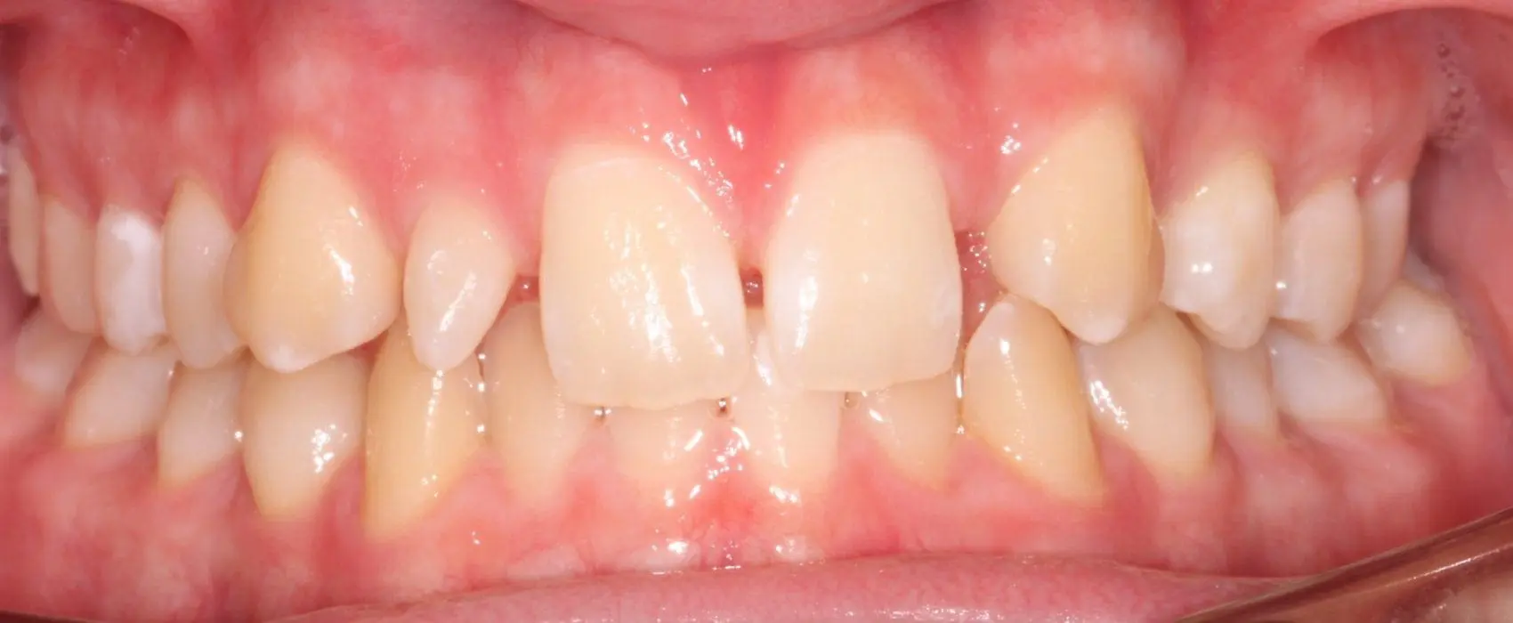 Missing and Peg Lateral Incisors
