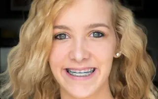 Debunking 7 Braces Myths