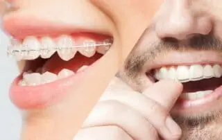Woman's and men's smile with clear aligner and dental braces on teeth