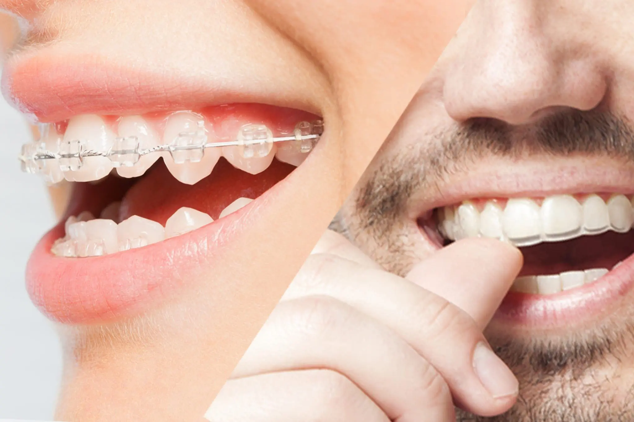 Woman's and men's smile with clear aligner and dental braces on teeth