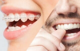 Woman's and men's smile with clear aligner and dental braces on teeth
